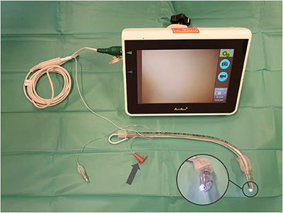 Tracheal Tube-Mounted Camera Assisted Intubation vs. Videolaryngoscopy in Expected Difficult Airway: A Prospective, Randomized Trial (VivaOP Trial)